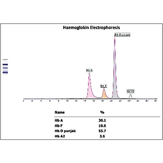 Hemoglobin (Hb) D Punjab